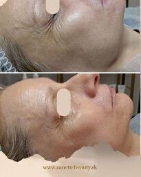 Hydratácia a lifting